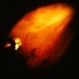 peripheral pre-retinal fibrosis and neovascularization with vitreous cutter